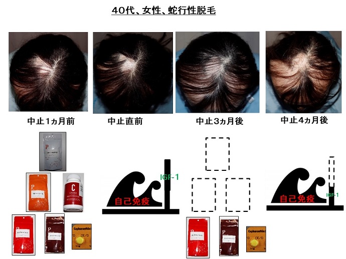 円形脱毛症　病院